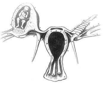 Tắc vòi trứng phụ nữ có thể bị vô sinh hoặc thai ngoài tử cung